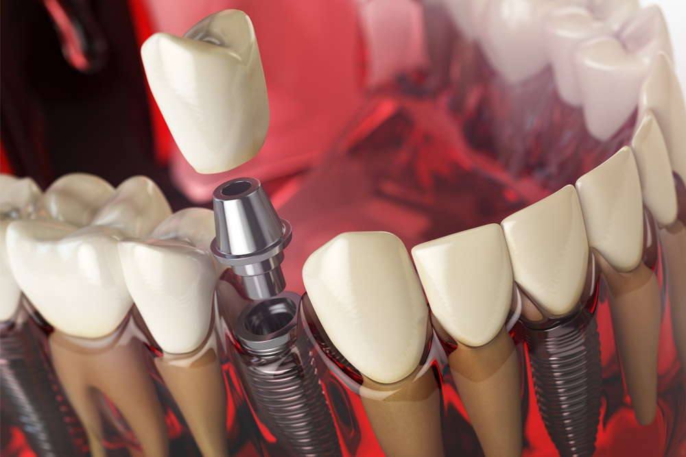 implant2