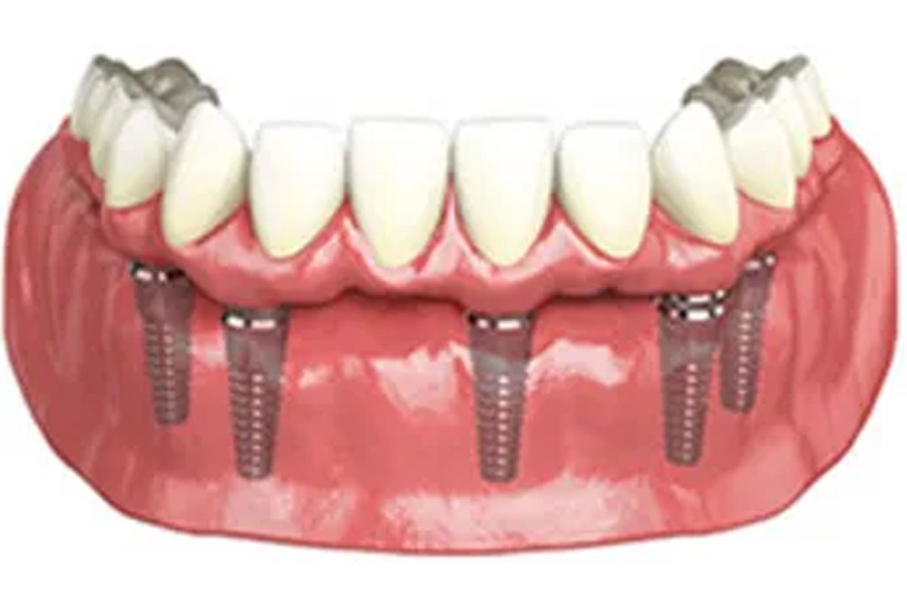 implant5